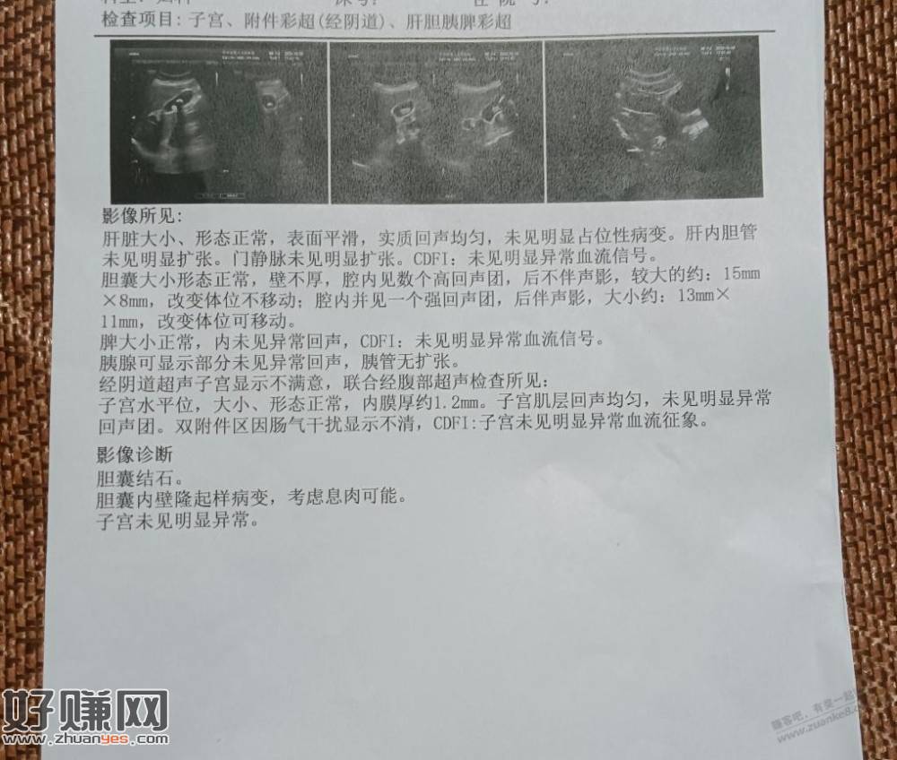 有了解结石的吧友吗