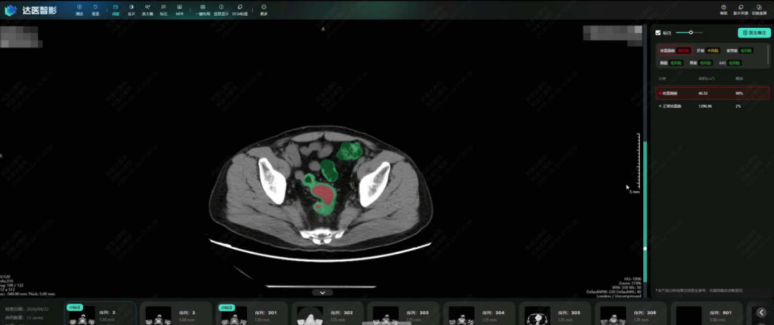 阿里发布第三个癌症AI模型：接连突破胰腺癌、胃癌、肠癌筛查难题