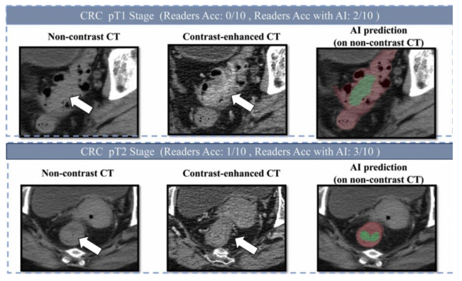 阿里发布第三个癌症AI模型：接连突破胰腺癌、胃癌、肠癌筛查难题